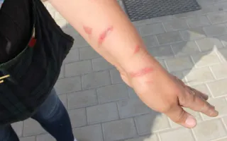 Ожоги борщевиком вновь зафиксированы в Севастополе